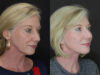Necklift case #2570 slider thumbnail