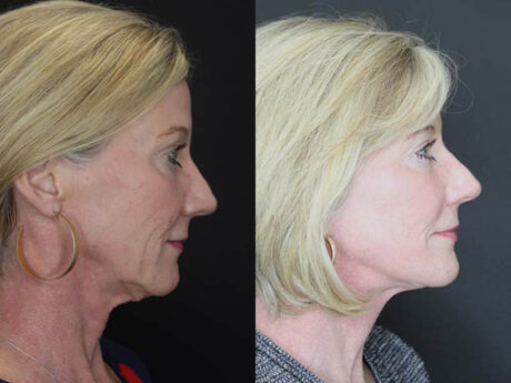 Necklift case #2570