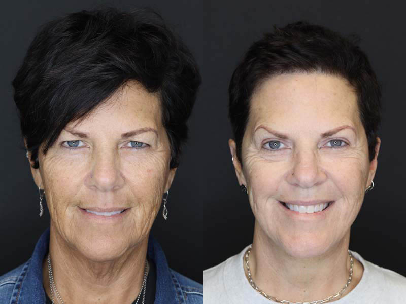 Necklift case #2577