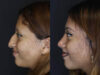 Rhinoplasty case #2591 slider thumbnail