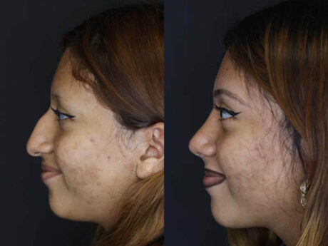 Rhinoplasty case #2591