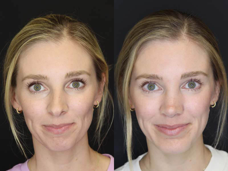 Rhinoplasty case #2584