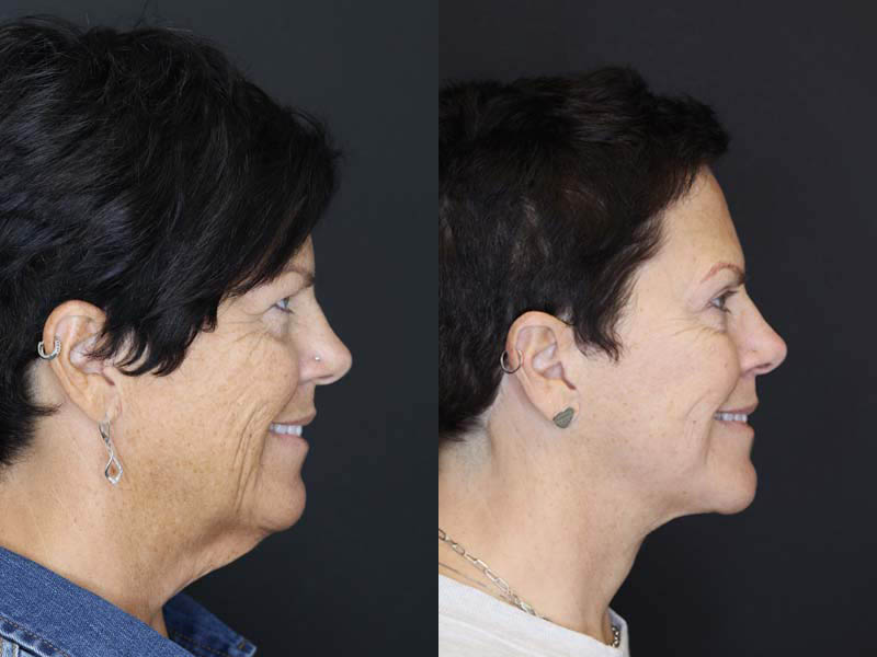 Necklift case #2577