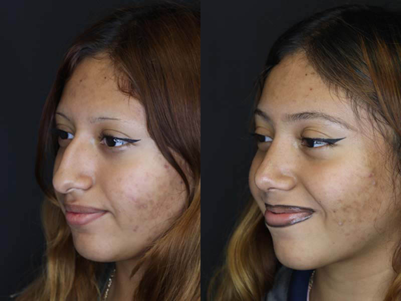 Rhinoplasty case #2591