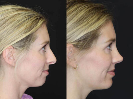 Rhinoplasty case #2584