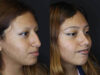 Rhinoplasty case #2591 slider thumbnail