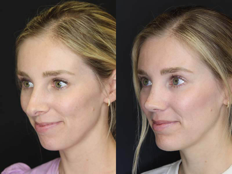 Rhinoplasty case #2584