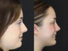 Rhinoplasty case #2600 slider thumbnail