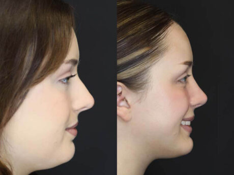 Rhinoplasty case #2600