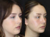 Rhinoplasty case #2600 slider thumbnail