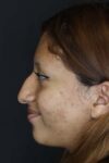 Rhinoplasty case #2591