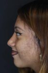 Rhinoplasty case #2591