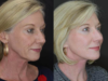 Facelift case #2652 slider thumbnail