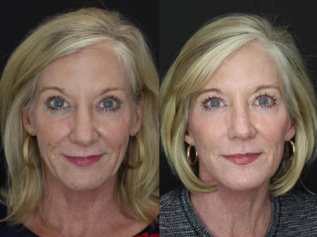 Facelift case #2652