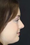 Rhinoplasty case #2600