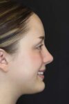 Rhinoplasty case #2600