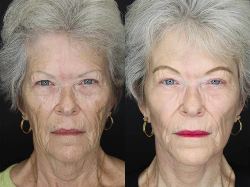 Facelift case #2560