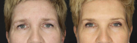 Blepharoplasty case #2634