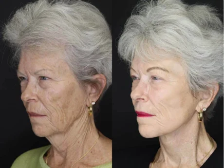 Facelift case #2560