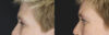 Blepharoplasty case #2634 slider thumbnail