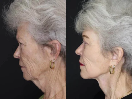 Facelift case #2560