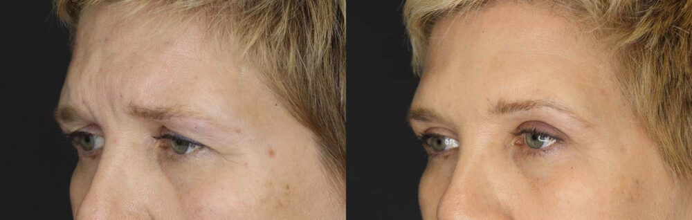 Blepharoplasty case #2634
