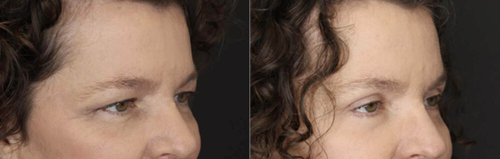 Blepharoplasty case #2641