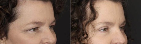 Blepharoplasty case #2641