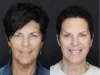 Facelift case #2651 slider thumbnail