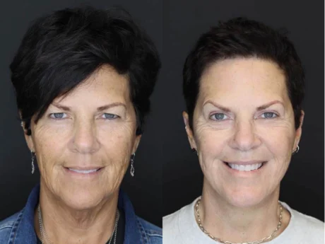 Facelift case #2651