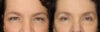 Blepharoplasty case #2641 slider thumbnail