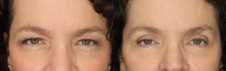 Blepharoplasty case #2641