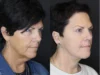Facelift case #2651 slider thumbnail
