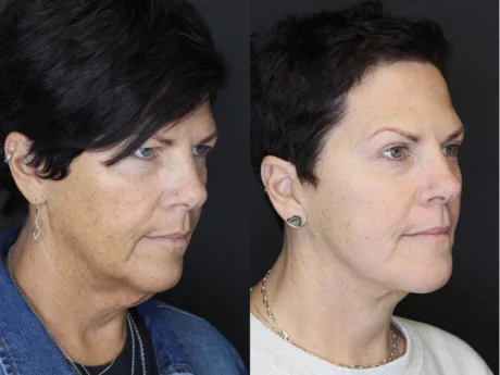 Facelift case #2651