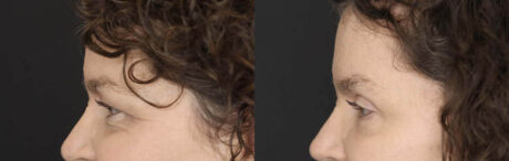 Blepharoplasty case #2641