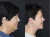 Facelift case #2651 slider thumbnail