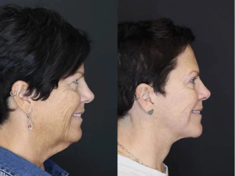 Facelift case #2651
