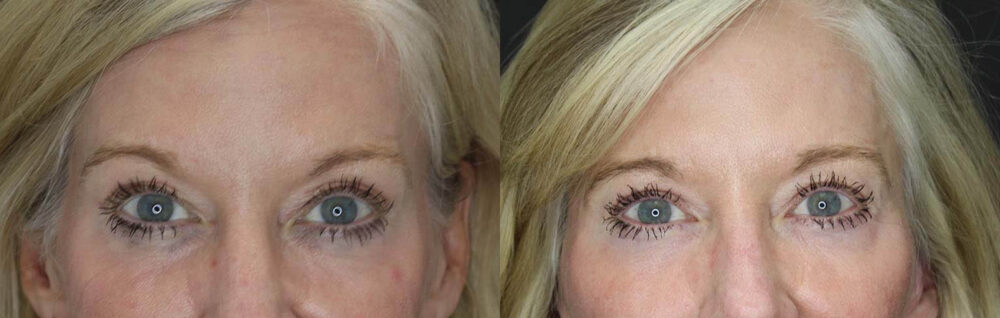 Blepharoplasty case #2713