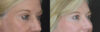 Blepharoplasty case #2713 slider thumbnail