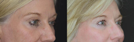 Blepharoplasty case #2713