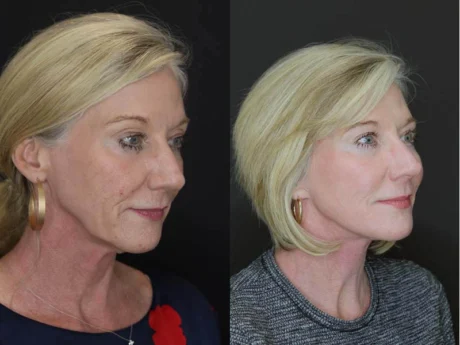 Facelift case #2652