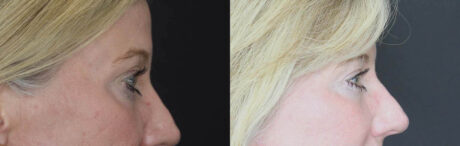 Blepharoplasty case #2713