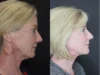 Facelift case #2652 slider thumbnail