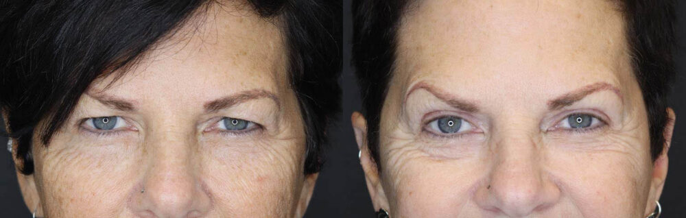 Blepharoplasty case #2705