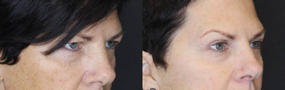 Blepharoplasty case #2705