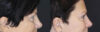 Blepharoplasty case #2705 slider thumbnail