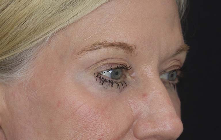 Blepharoplasty case #2713