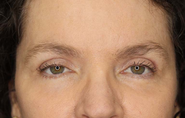 Real Patient Upper Eyelid Surgery after #1