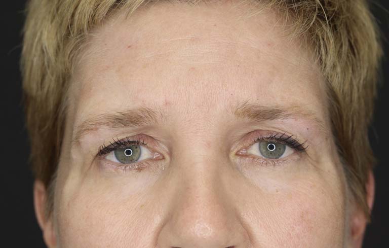 Blepharoplasty case #2634