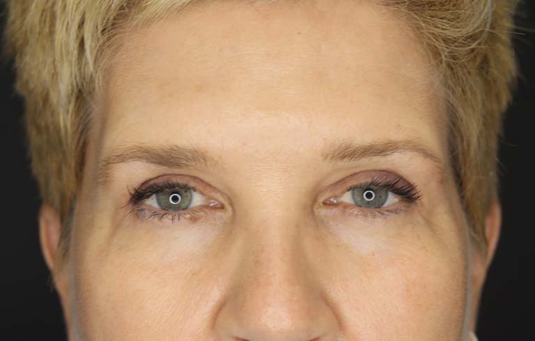 Blepharoplasty case #2634